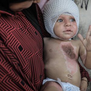 gazzede vucudu yanan 1 yasindaki muhammed yardim bekliyor rhkWCgls